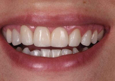 imagen que muestra una sonrisa perfecta después de realizar tratamiento de Carillas y Alargamiento Coronario en Aura Odontología Digital