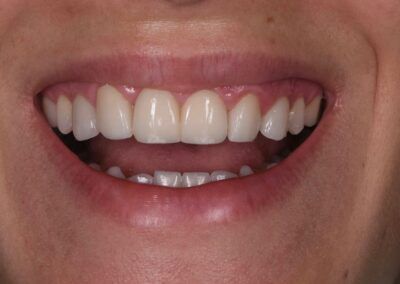 imagen que muestra una sonrisa perfecta después de realizar tratamiento de Carillas y Alargamiento Coronario en Aura Odontología Digital